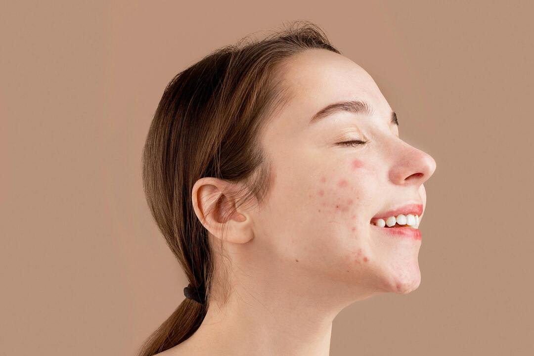 Acne: Causes, Treatment, and Prevention